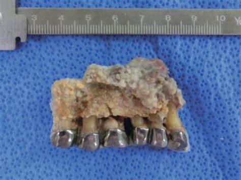 Medication Related Osteonecrosis Of The Jaw Intechopen