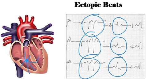 Ectopic Heart Beats Drvaibhavpatil