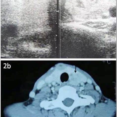 A Thyroid Ultrasound Displaying A Solitary Heterogeneous Nodule Which Download Scientific