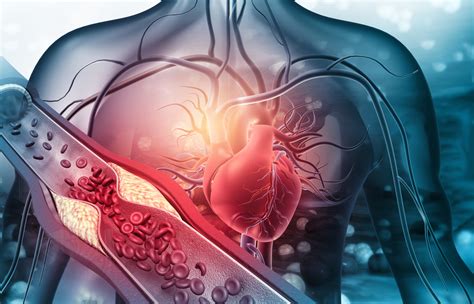 Facteurs De Risque Cardiovasculaire Et Complications Illustrations