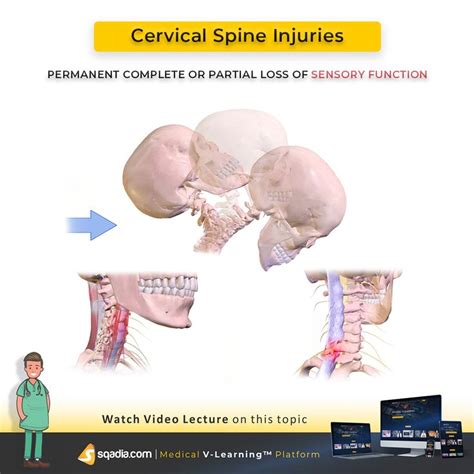 Cervical Spine Injuries Medical Videos Cervical Injury