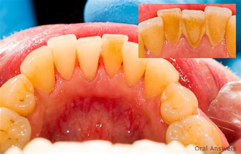 White Stuff Between Teeth And Gums Teethwalls