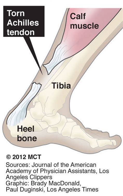 Diagram showing the tendons and ligaments of the ankle and. A calf injury can take few months to heal if it's a major ...