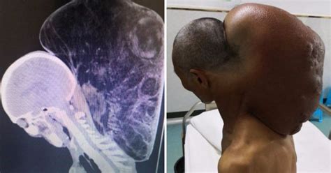 Mans Massive Neck Tumour Has Been Growing For 47 Years Metro News