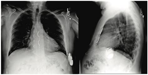 Extravascular Icd With A Lead Under The Sternum Epld