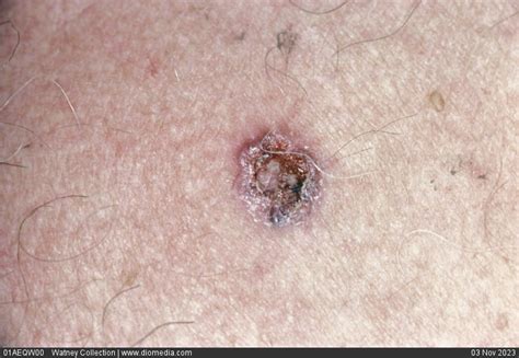Stock Image Close Up Of A Basal Cell Carcinoma Or Rodent Ulcer On The