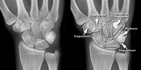 Xray Of Hand Bones