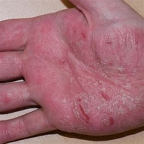 Whats The Best Treatment For Hand Eczema Help Researchers Find Out