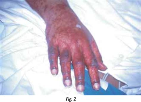 Figure 2 From Purpura Fulminans Due To Enterococcus Faecalis
