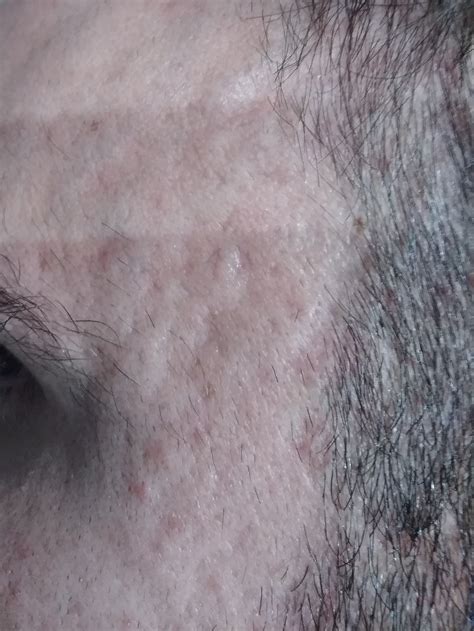 Best Treatment For These Scars On Temples Pics Scar Treatments