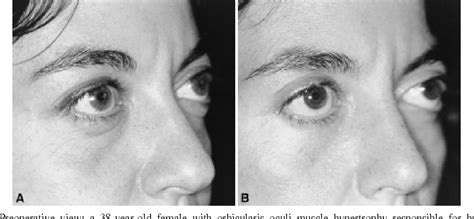 Treatment Of Orbicularis Oculi Muscle Hypertrophy In Lower Lid
