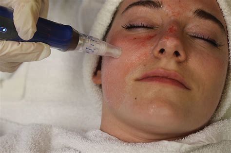 Chelsea Is Shrinking Her Pores With Microneedling