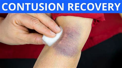 Contusion Recovery Youtube