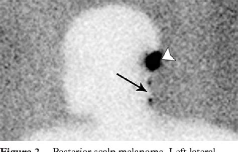 Figure 2 From Lymphoscintigraphy In Cutaneous Melanoma An Updated