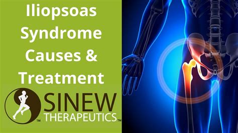 Iliopsoas Syndrome Causes And Treatment Youtube