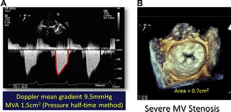 Pre And Post Operative Diastolic Dysfunction In Patients With Valvular