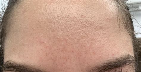 Acne Uneven Skin And Pores On Forehead In Need Of Help