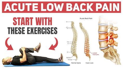 How To Eliminate Acute Low Back Pain YouTube