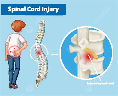 Free Vector Diagram Showing Spinal Cord Injury
