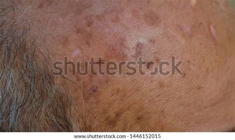 Age Spots Front Bald Head Old Stock Photo 1446152015 Shutterstock
