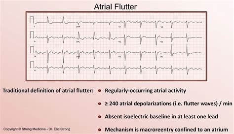 Atrial Flutter On EKG Regularly Occurring Atrial GrepMed Hot