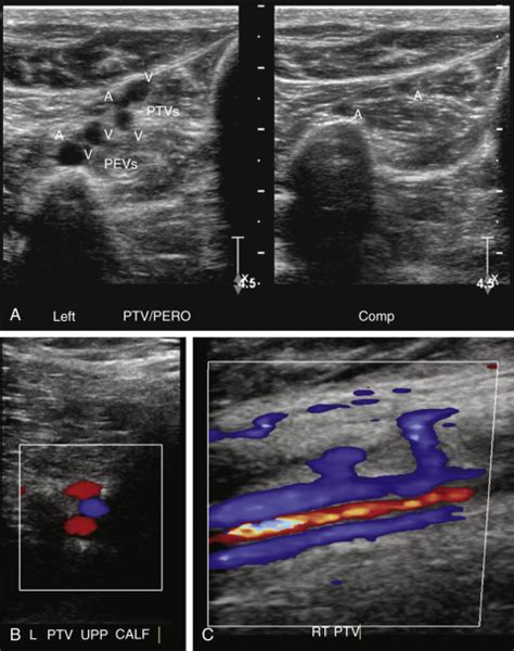 Gastrocnemius Vein Ultrasound