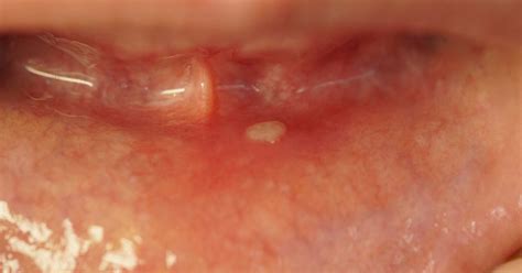 White Spots On Gums From Smoking