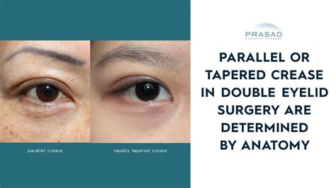 parallel or tapered eyelid crease for asian eye surgery