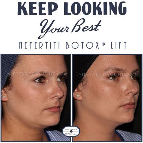 Nefertiti Botox Lift Botox Nefertiti Plastic Surgery