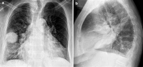 Pleural effusion (transudate or exudate) is an accumulation of fluid in the chest or on the lung. Pleural Disease | Radiology Key