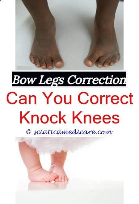 Permanent Remedy For Bow Legs What Does Bowlegged Look Likehow To