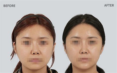 Septoplasty The Center Of The Face Is Recreated 【id Hospital】