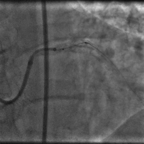 3 × 23 Mm Xience Xpedition Stent Abbott Vascular Placed In Mid‐lad