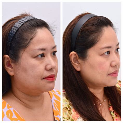 Ultherapy Review Reverse Signs Of Aging With Halley Medical Aesthetic
