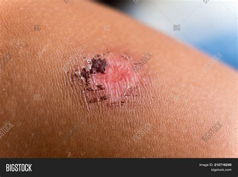 Red Bloody Wound Image And Photo Free Trial Bigstock