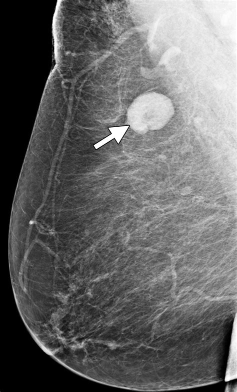 Axillary Staging Of Breast Cancer What The Radiologist Should Know
