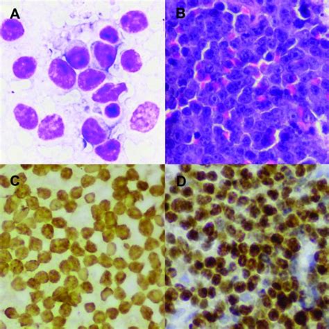 Diffuse Large B Cell Lymphoma High Grade A Cytopathology Revealed