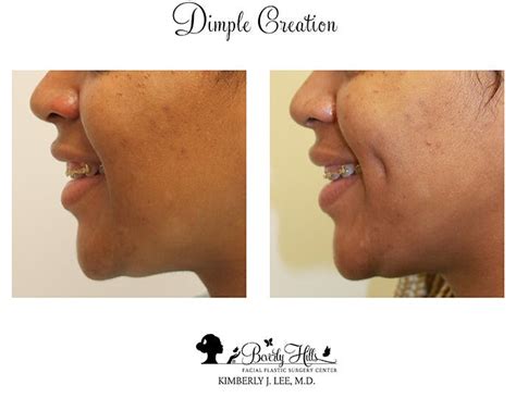 Dimple Creation Before And After Photos Dr Kimberly Lee