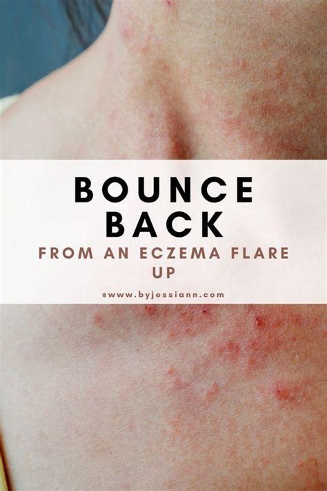 Bad Eczema Flare Up 11 Tips To Bounce Back In 1 Week By Jessi Ann