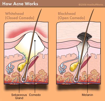 Banyak sangat cara nak hilangkan whitehead & blackhead. CARA HILANGKAN WHITEHEAD DAN BLACKHEAD SECARA SEMULAJADI ...