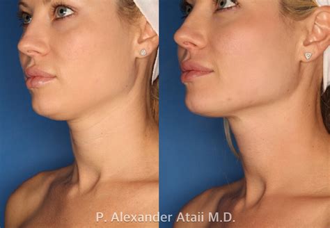 Patient Ultherapy Before After Photos Laser Cliniqúe
