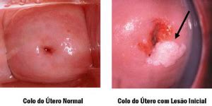 Fotos de luto para perfil do face. Cancerul testicular, Testicular cancer tumor marker