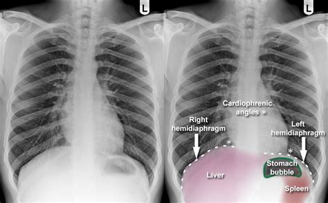 Chest X Ray Anatomy Diaphragm