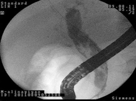 Endoscopic Retrograde Cholangiopancreatography Image Revealing A Linear