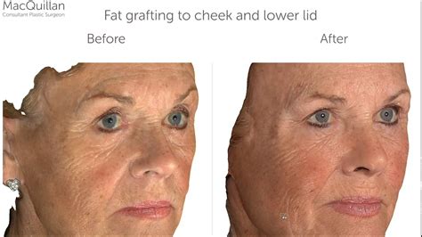 Fat Grafting To Cheeks And Lower Lids Youtube