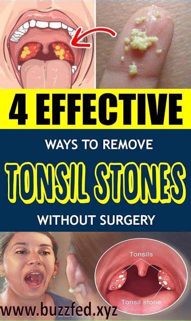 How To Get Rid Of White Spots In Tonsils How