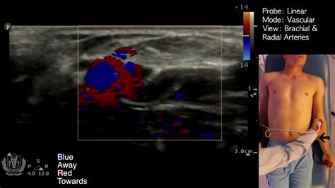 Vascular Doppler Using Ultrasound Made Simple Youtube