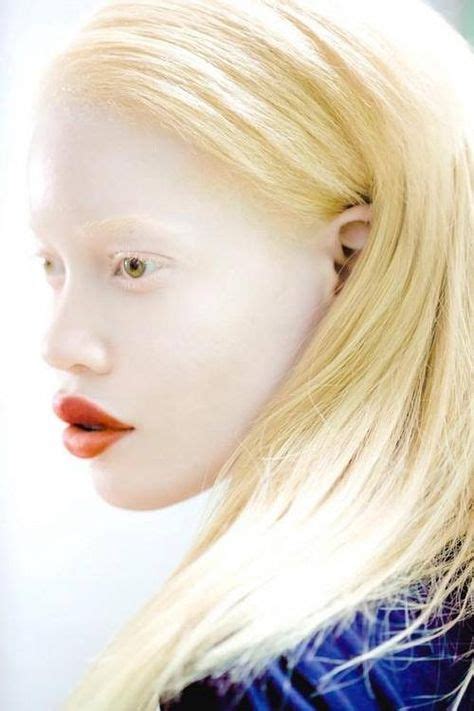 Beautiful Black Albinos Ideas Albinism Albino Black Beauties