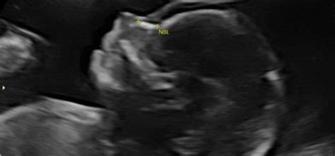 Prenatal Imaging Ultrasound And Magnetic Resonance Imaging