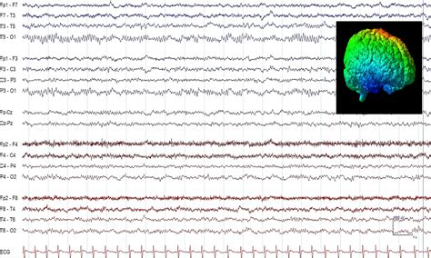 Badanie EEG informacje dla techników EEG Elektroencefalografia